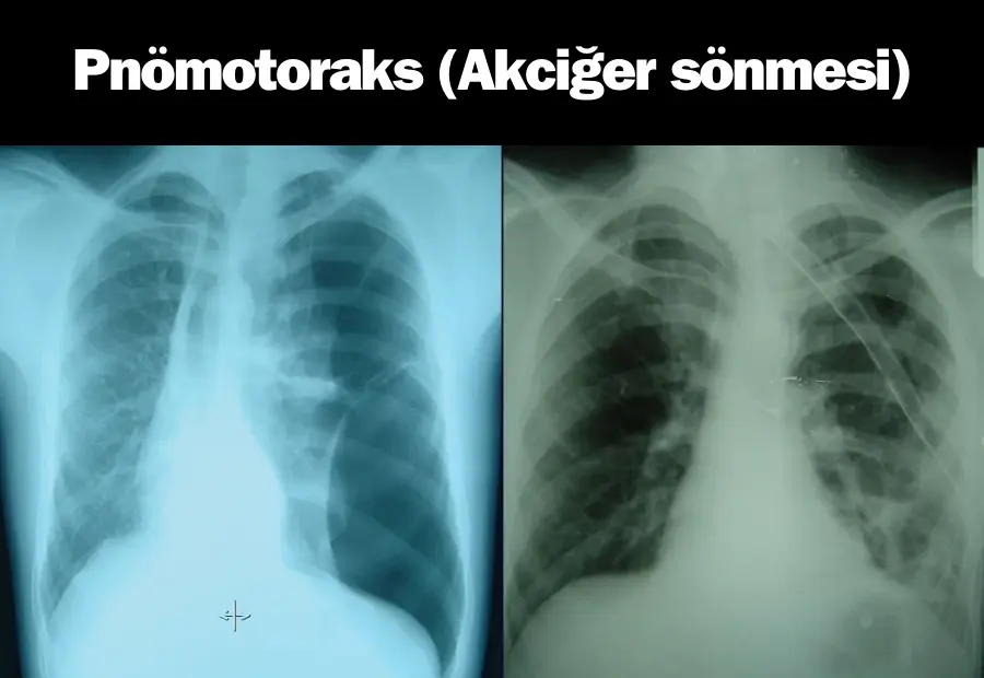 akciğer çökmesi, akciğer sönmesi, pnömotoraks, akciğer hastalığı