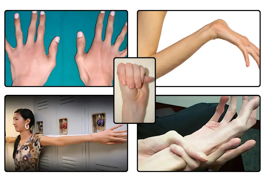 marfan sendromu, marfan sendromu nedir, marfan sendromu nedir tıp, marfan sendromu görseller, marfan sendromu belirtileri, marfan sendromu tedavisi, iskelet bozukluğu