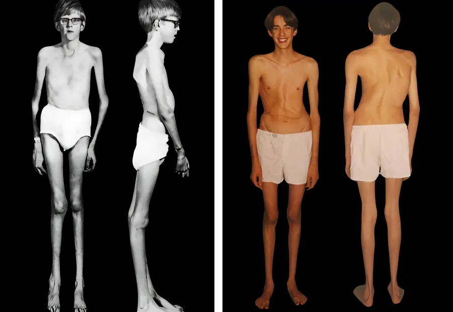 marfan sendromu, marfan sendromu nedir, marfan sendromu nedir tıp, marfan sendromu görseller, marfan sendromu belirtileri, marfan sendromu tedavisi, marfan sendromu zeka, marfan sendromu kaç yıl yaşar, marfan sendromu engelli raporu, iskelet bozukluğu