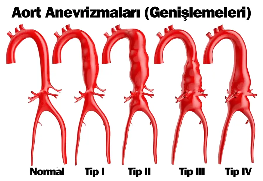 aort anevrizması, aort anevrizmaları, aort genişlemesi