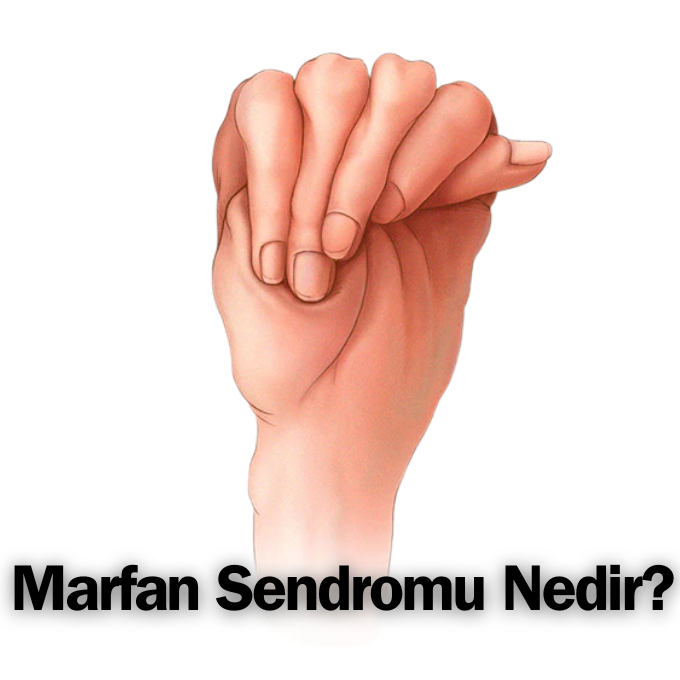 marfan sendromu nedir, marfan sendromu belirtileri, marfan sendromu tedavisi, marfan sendromu nedir tıp, marfan sendromu zeka, marfan sendromu görseller
