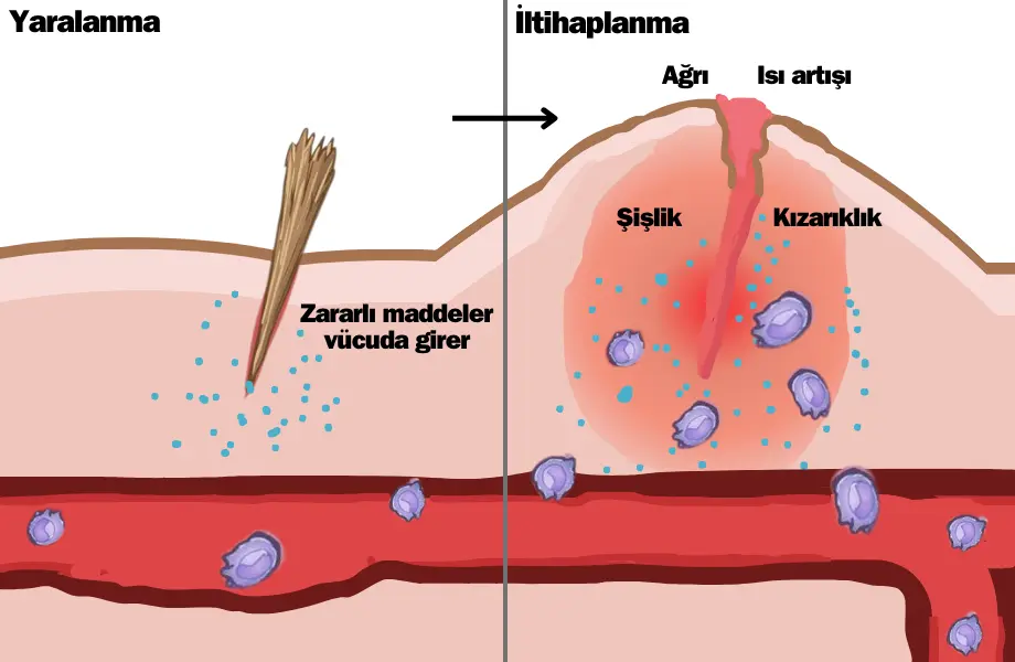 inflamasyon nedir, inflamasyon, inflamasyon savunma, inflamasyon iltihaplanma, iltihaplanma, iltihaplanma patoloji, iltihaplanma diyagram, inflamasyon diyagram