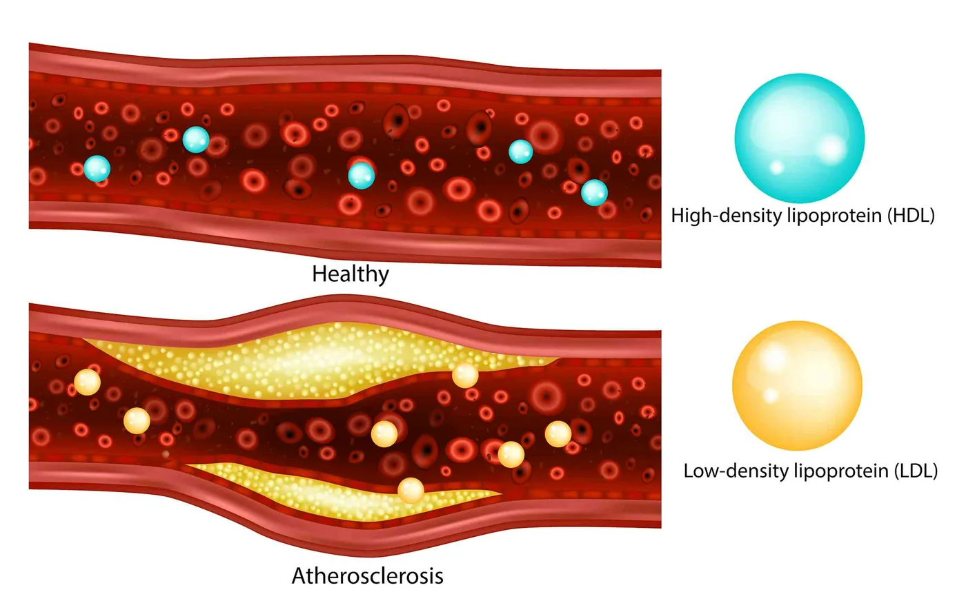Comparison of a healthy blood vessel and an artery narrowed by atherosclerotic plaque buildup affecting cholesterol control.