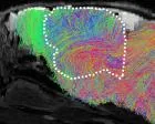 Laboratory research on mice with human brains where transplanted human organoids integrate into rodent neural circuitry.