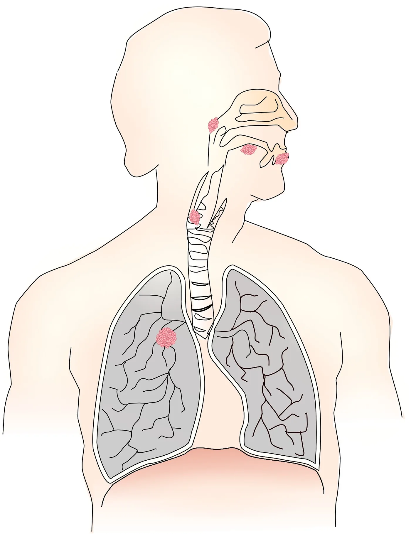 Medical visualization of human lung tissue studied in hereditary cancer risk programs.