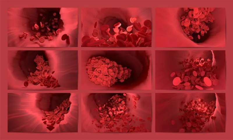 Microscopic view of blood clot formation inside a human blood vessel.