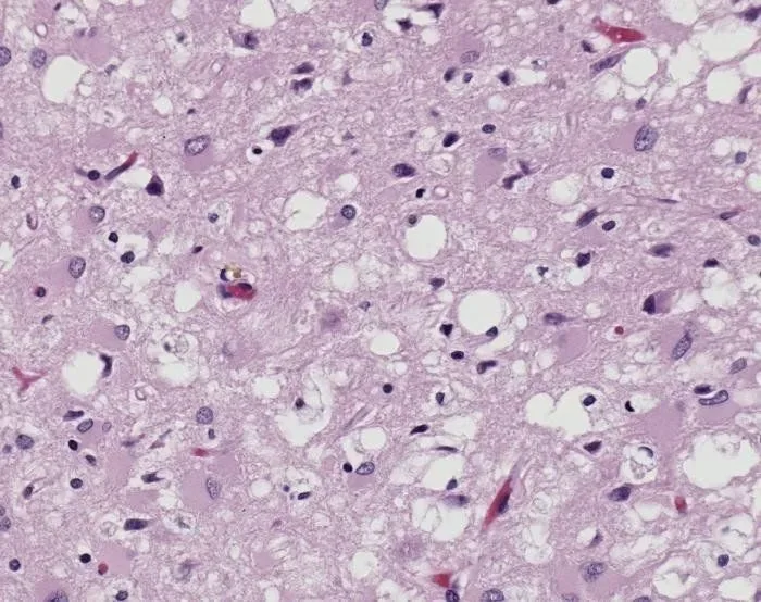 Histological section of brain tissue showing variant Creutzfeldt-Jakob disease changes