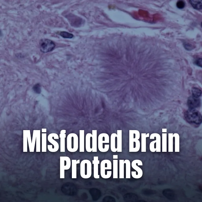 Microscopic tissue view showing an amyloid prion protein plaque surrounded by damaged cells