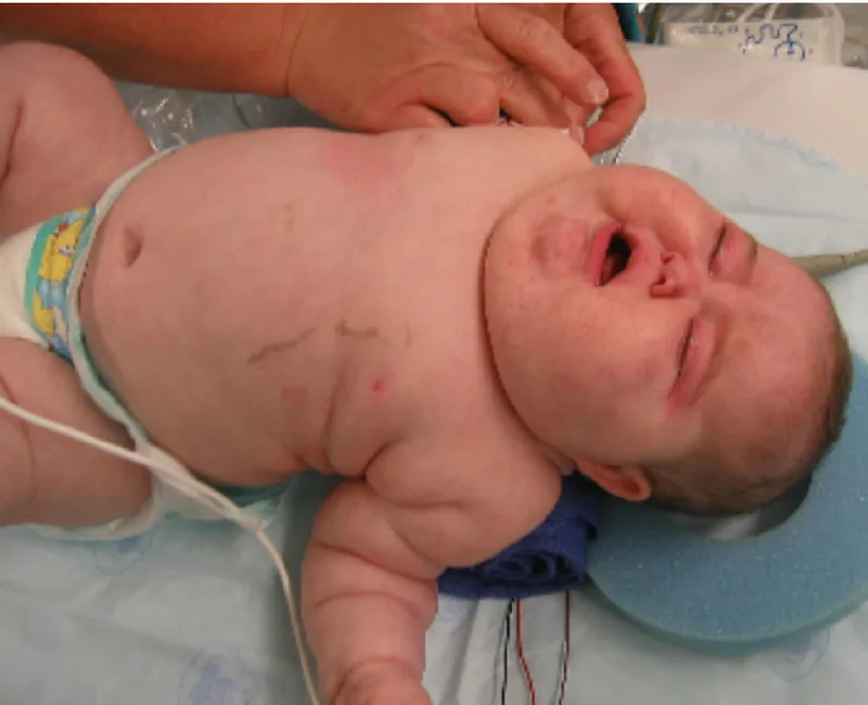 Clinical presentation of hypercortisolism in an infant with Cushing syndrome.